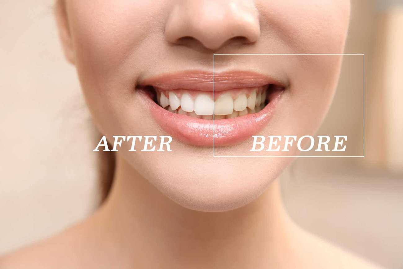How Can You Maintain a Consistent Smile Shade with Crowns St albans?