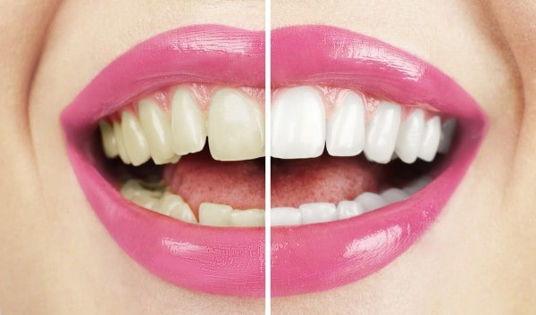 What Makes Ultima White Teeth Whitening Different St albans