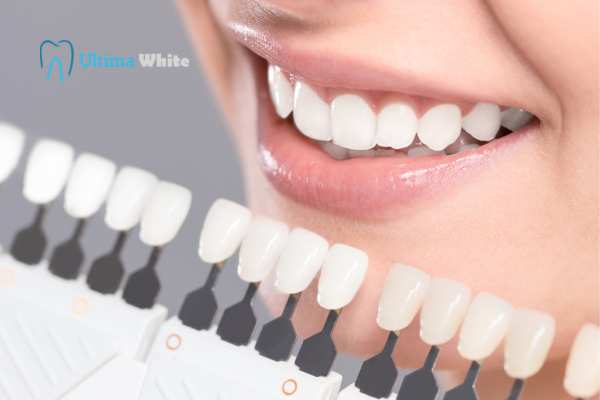 How to Maximise the Results of Your Laser Teeth Whitening Treatment St albans
