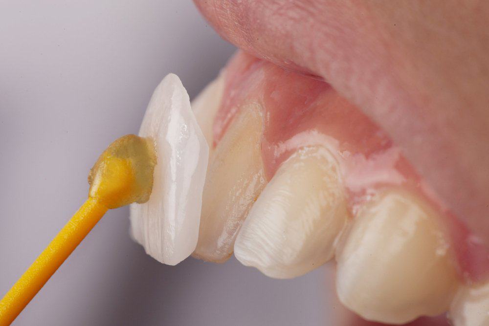 Dental Veneers: Achieving a Flawless Look St albans