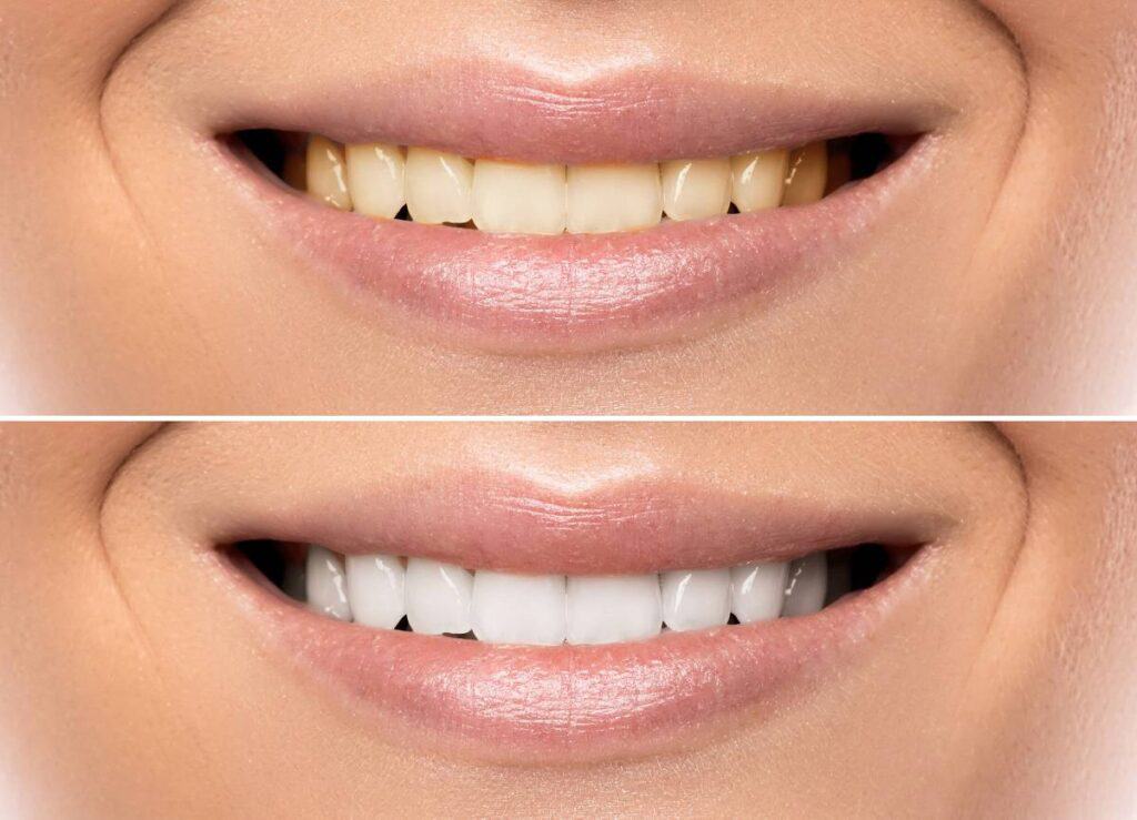 How Does Gum Disease Progress if Left Untreated St albans?