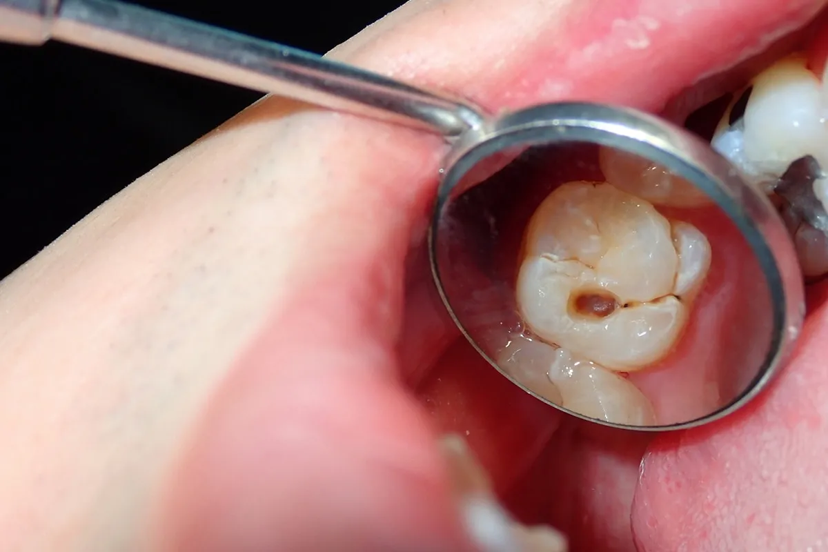 Why Do Teeth Crack? Common Causes to Know St albans