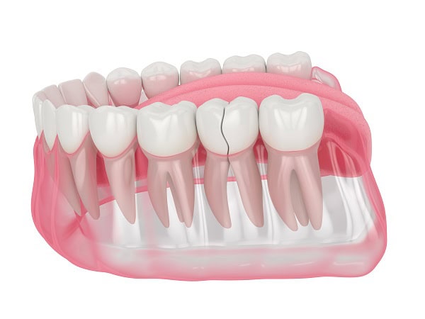 How Can You Manage Pain and Discomfort After a Root Canal St albans?