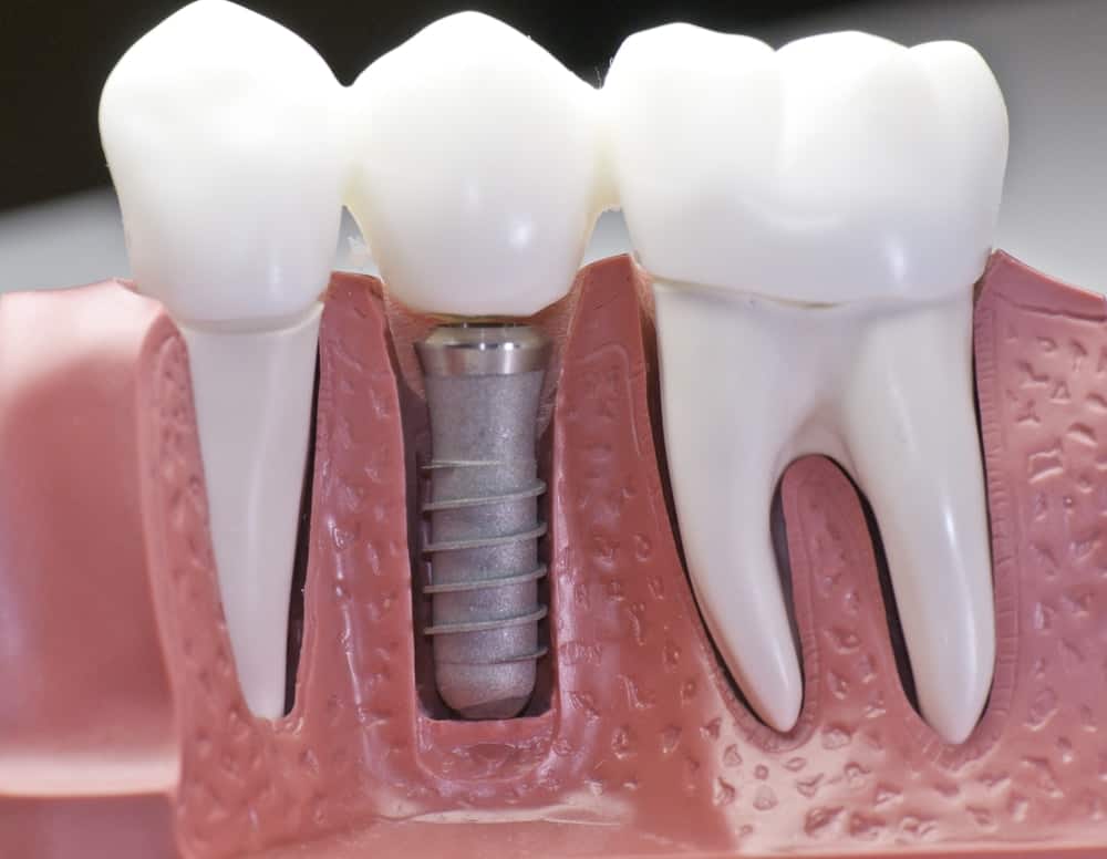 Common Misconceptions About Modern Dental Treatments St albans