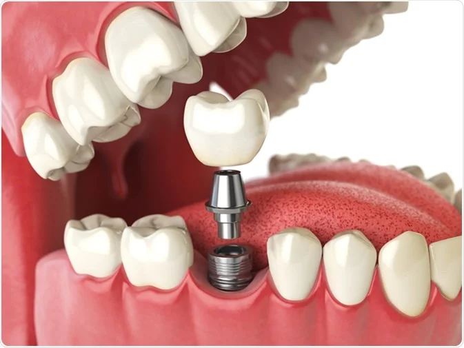 How Do I Decide Which Tooth Replacement Is Right for Me St albans?