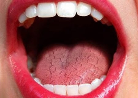 Dry Mouth and Its Role in Tooth Decay St albans
