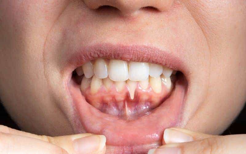 How Can Gum Disease Be Prevented St albans?