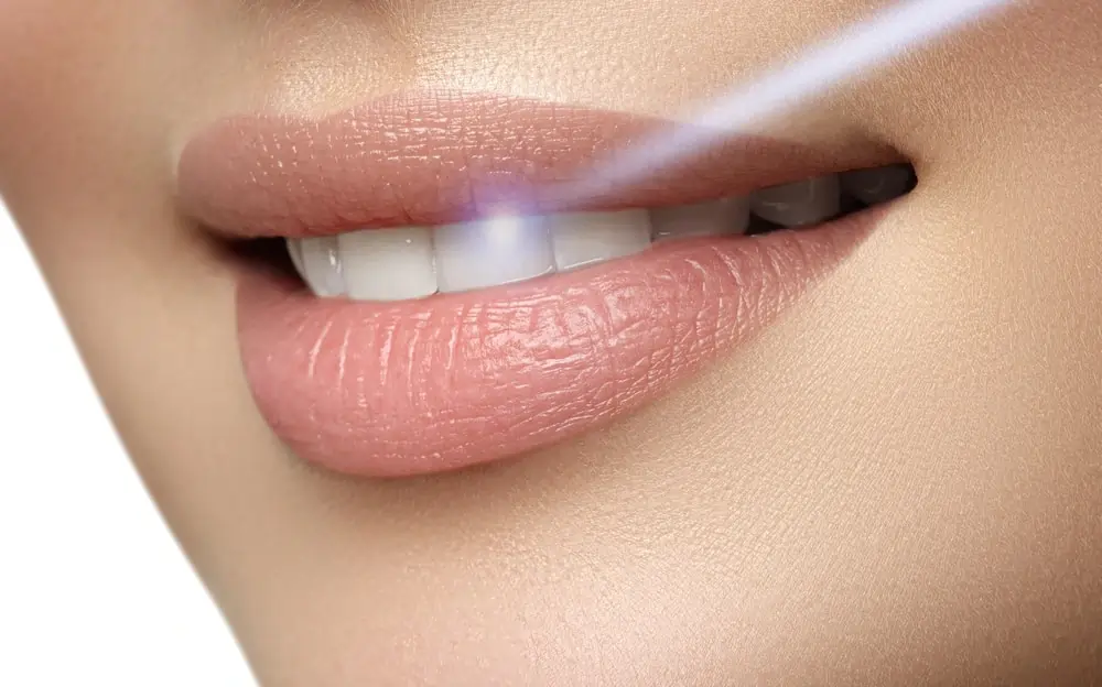 How Long Does Laser Teeth Whitening Last on Your Teeth St albans?