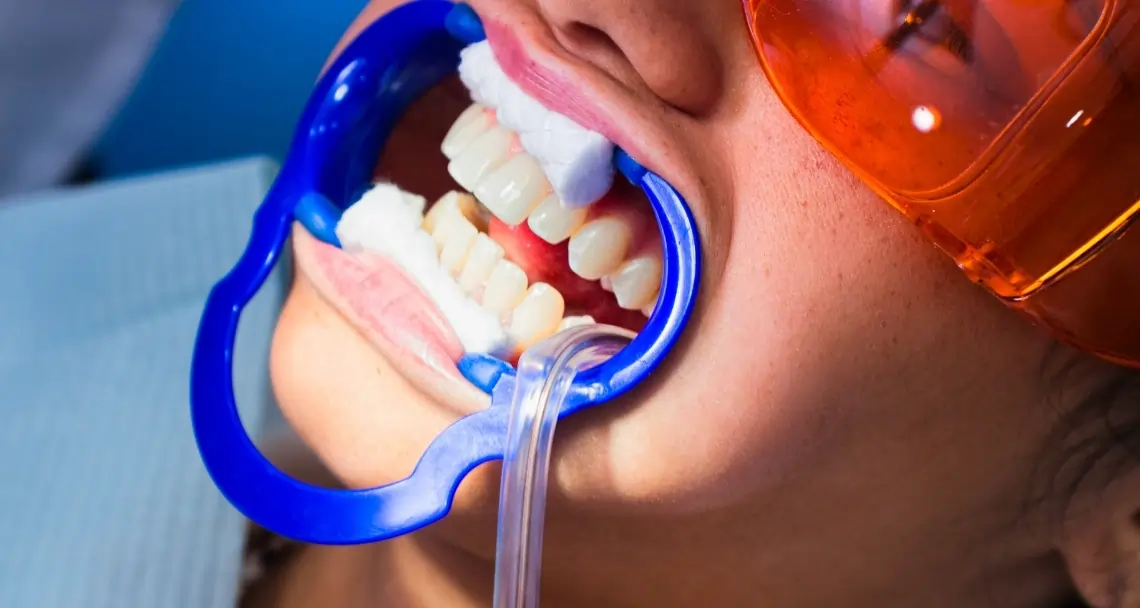 How Teeth Whitening Treatments Actually Work on Your Enamel St albans