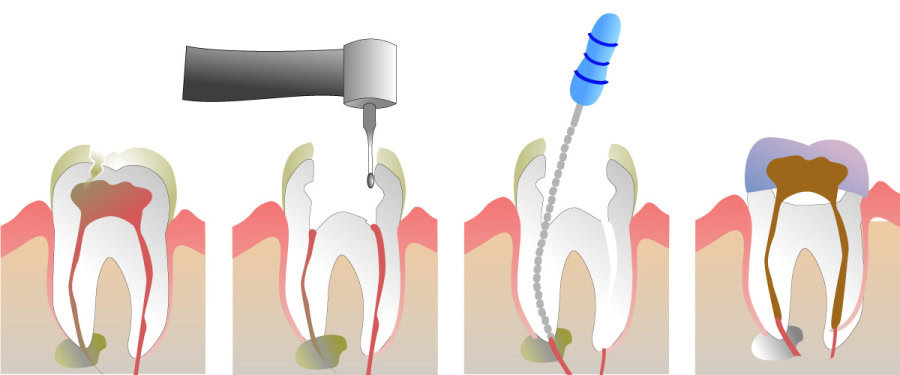 How Do You Properly Care for Your Teeth After a Root Canal St albans