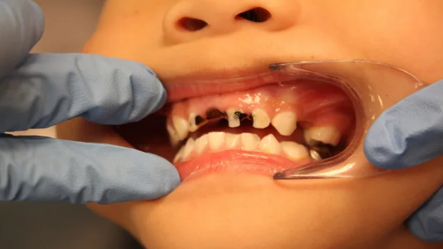 Which Foods and Drinks Cause the Most Damage to Young Smiles St albans?