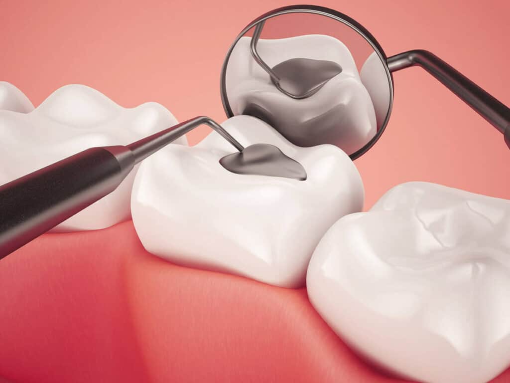 How Can You Prevent Tooth Decay Effectively St albans