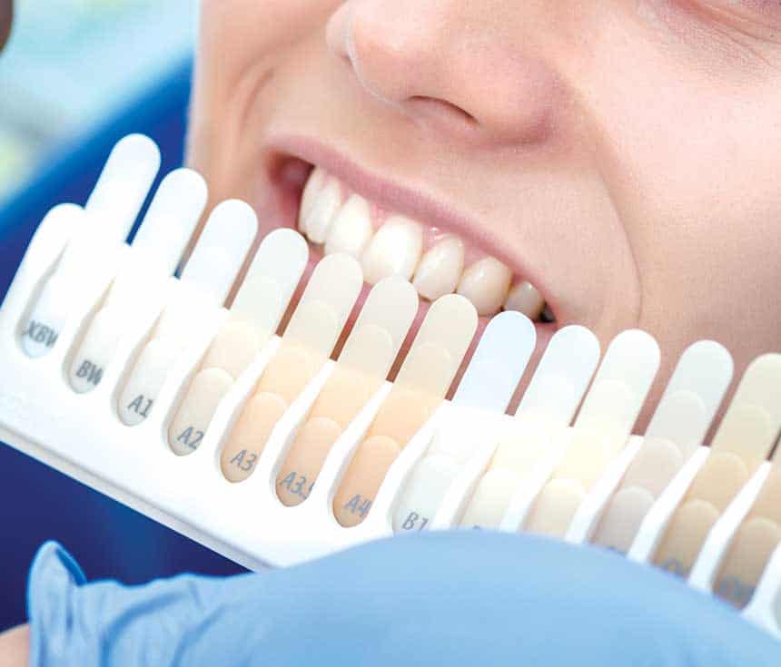 Is Laser Teeth Whitening Worth It for a Brighter, Confident Smile St albans?
