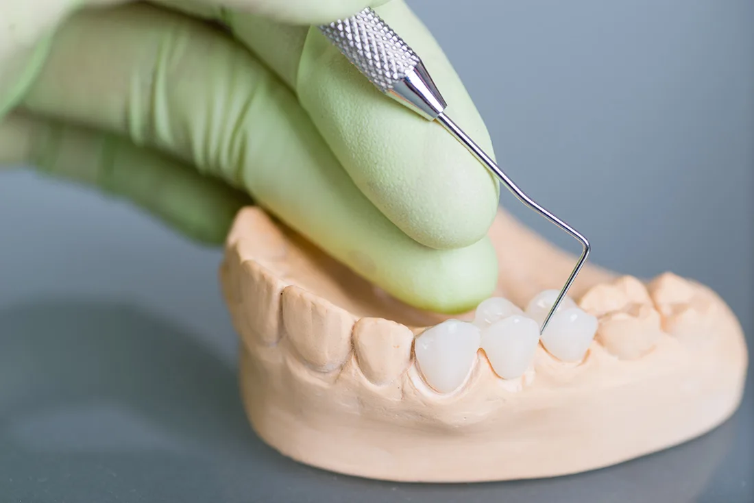 Do Braces Take Years to Show Results St albans