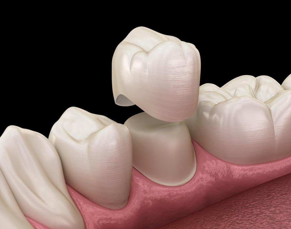 Teeth Whitening: Separating Facts from Fiction St albans