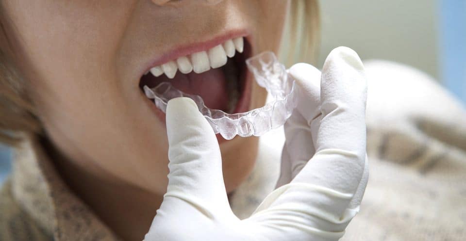 Why Bleaching Trays Require More Time St albans
