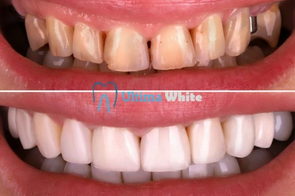 What Makes Instant Teeth Whitening Treatments So Popular St albans?