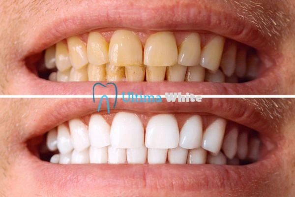Stained Teeth and Persistent Bad Breath St albans