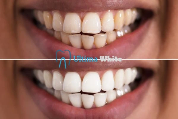 Aftercare Tips to Maintain Your New Smile St albans